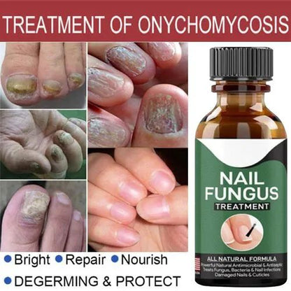 Fast Nail Fungus Treatment & Repair Serum | Anti-Fungal Nail Care Gel