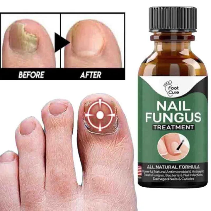 Fast Nail Fungus Treatment & Repair Serum | Anti-Fungal Nail Care Gel