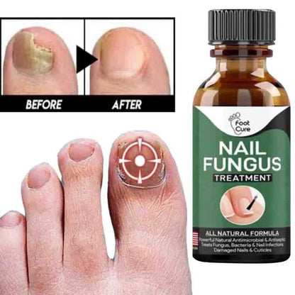 Fast Nail Fungus Treatment & Repair Serum | Anti-Fungal Nail Care Gel
